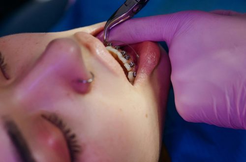 how to brush teeth with braces